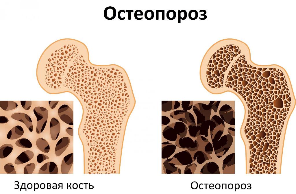 Как выглядит остеопороз