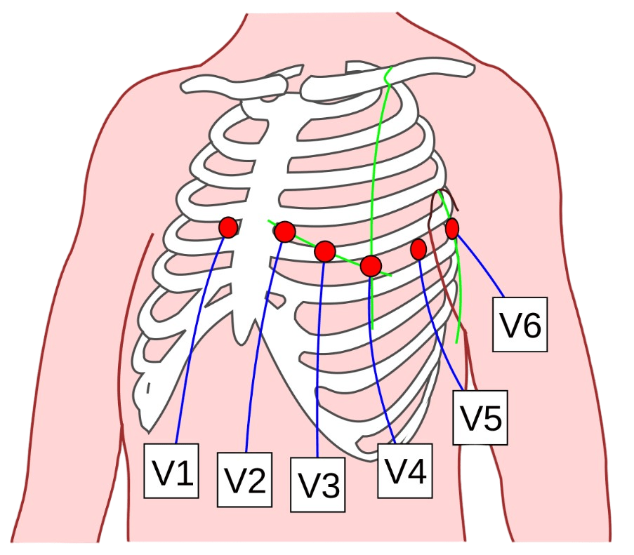 Схема расположения грудных электродов при снятии ЭКГ
